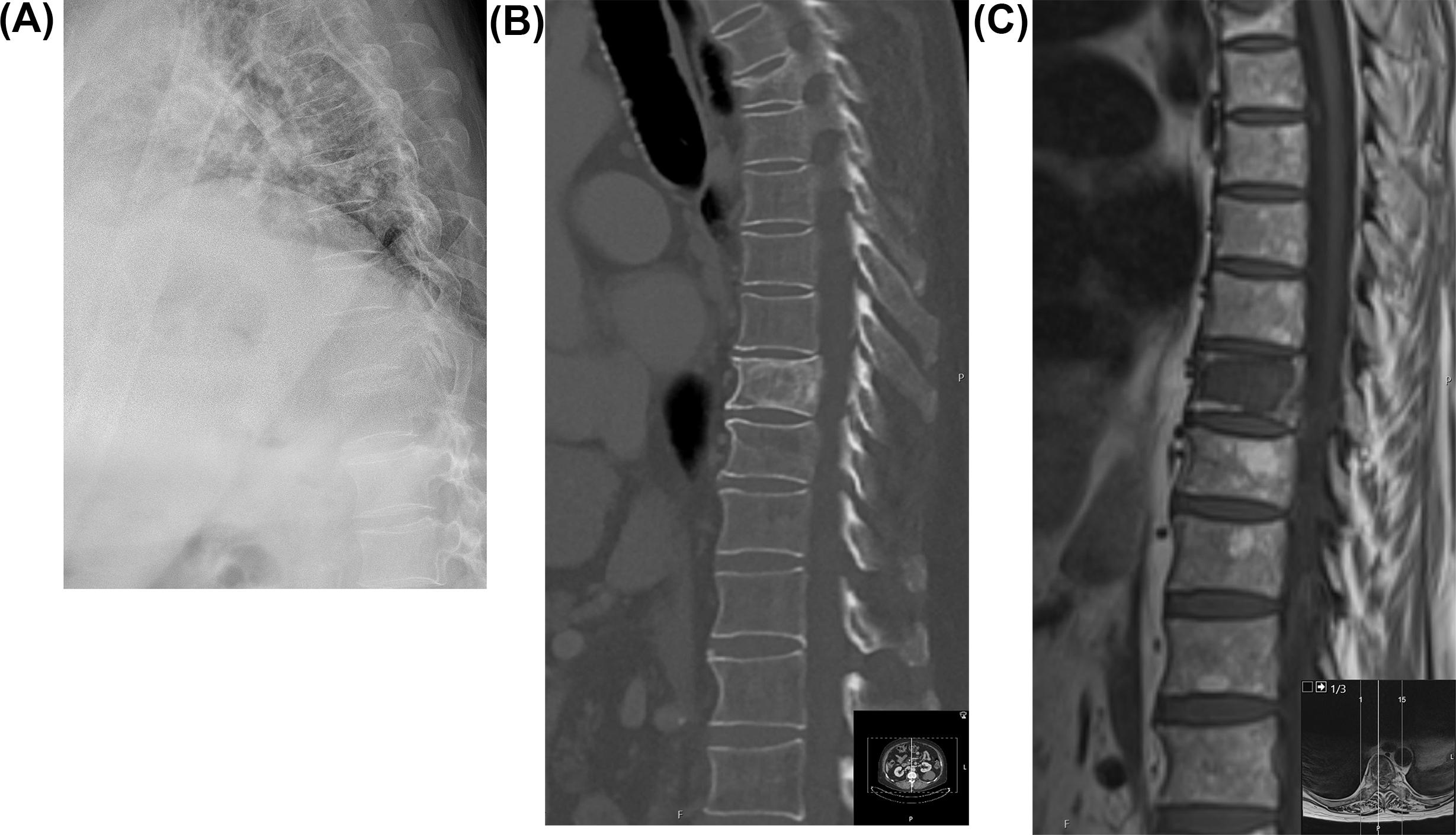 Figure 7.4, (A) Lateral plain radiographs, (B) sagittal CT, and (C) T1-weighted images of an 83-year old patient with a T4 osteoporotic fracture and T9 metastasis, which are difficult to view on plain radiographs but are clearly identified on CT and MRI. CT is superior in demonstrating matrix characteristics of lesions as well as delineating the bony cortices. MRI is superior in identifying the lesions, and assessing the impact on the spinal cord and the adjacent nerve roots. In addition, MRI offers more accurate assessment of bone marrow; thereby, identifying bony metastasis and other malignancies prior to tumors causing vertebral bone destruction that could be identified on CT.