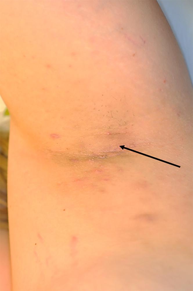 Fig. 13.1, Hurley stage I. Axilla with scattered inflammatory papules and pustules as well as a subcutaneous painful nodule (arrow) .