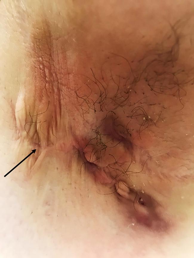 Fig. 13.2, Hurley stage II. Axilla with tunnel and scarring due to hidradenitis suppurativa and prior surgical excision (arrow).