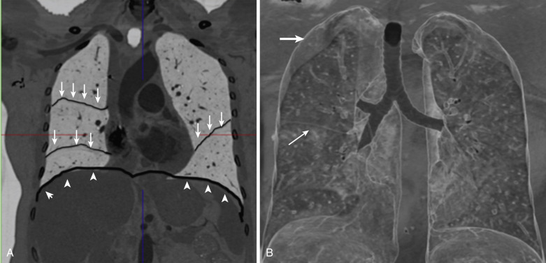 FIG 39-1, A, Inverted coronal CT image showing the fissures (arrows) and the diaphragm (arrowheads). B, Parietal pleura (thick arrow) and visceral pleura (thin arrow).
