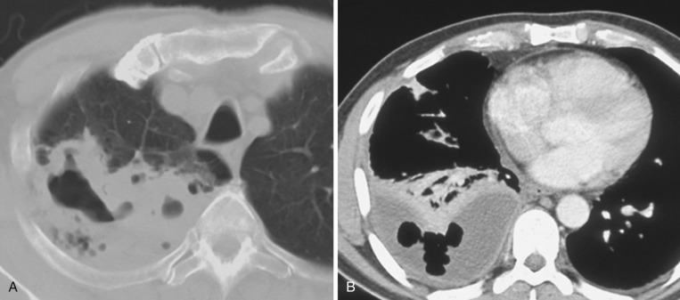 FIG 39-12, A, Axial CT image in a patient with right upper lobe necrotizing pneumonia with evidence of irregular cavitation within a right upper lobe consolidation. B, Another patient with an evolving right lower lobe pneumonia and a right hydropneumothorax with subtle pleural thickening, suggestive of an empyema.