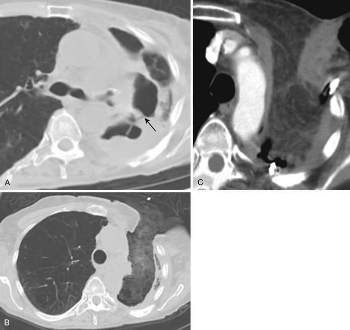 FIG 39-11, A, Axial CT image showing a bronchopleural fistula in the left upper thorax and a nonresolving left upper lobe pneumonia. B, Postsurgical débridement and a Clagett window and ( C ) post closure of Clagett window with a latissimus dorsi flap after the infection healed.