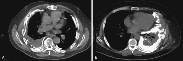 FIG 39-13, A, Axial CT image showing bilateral pleural plaques—both calcified and noncalcified—in a patient with asbestos exposure. B, Diffuse pleural thickening with dystrophic calcification in a patient with left-sided pleural metastasis from osteosarcoma.