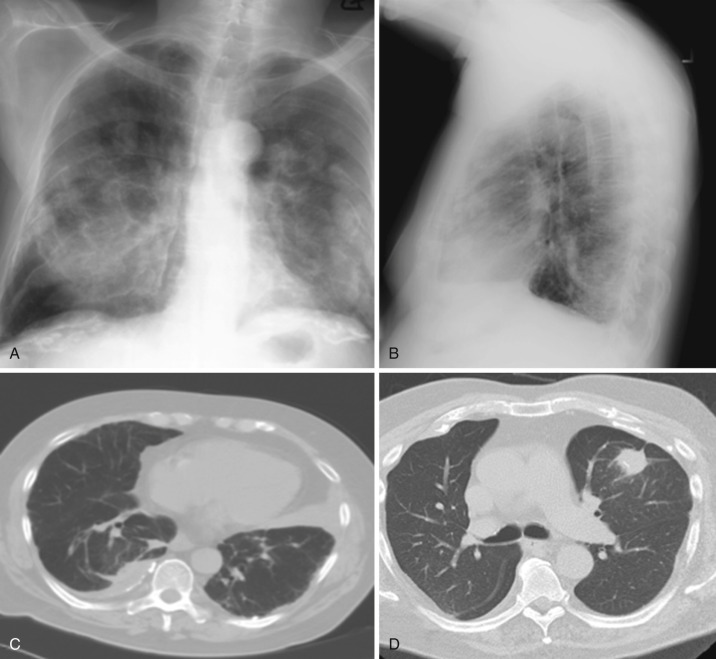 FIG 39-14, PA ( A ) and lateral ( B ) radiographs showing bilateral pleural plaques. C and D, Axial CT images showing consolidative opacities in the right lower lobe and left upper lobe that are characterized by round, masslike shape, associated bronchovascular “comet tails”, and broad-based interfaces with thickened adjacent pleura.