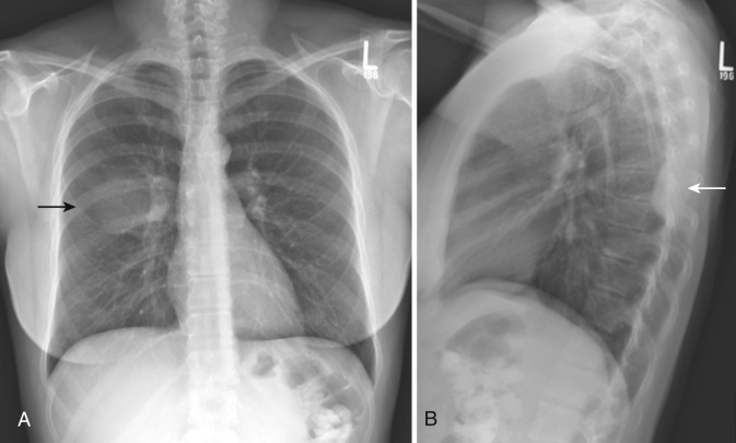 FIG 39-2, Chest PA ( A ) and lateral ( B ) radiographs showing a right upper pleural mass (arrows). Note that the inner border of the mass is tangential to the x-ray beam and is well defined by the adjacent lucent lung; the outer margin is ill defined.