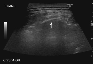 FIG 39-3, Ultrasound image of the pleura in a patient with mesothelioma; arrow points to the parietal pleura. Note the horizontal repetitions of the pleural line, seen deep to the visceral pleura.