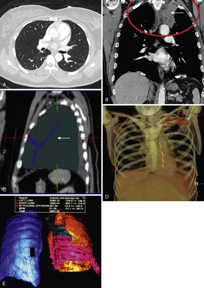 FIG 39-4, A, Axial CT image in a normal individual. B, Coronal CT image with left apical pleural tumor. C, Sagittal CT image with fissural involvement. D, Volume-rendered image shows left-sided pleural tumor and its relationship to the left internal mammary vessels. E, Volumetric assessment using 3D volume-rendering technique.