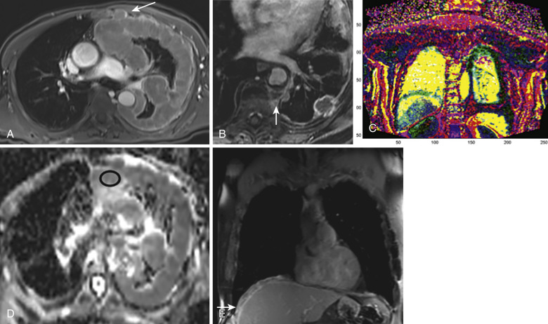 FIG 39-5, MRIs showing pleural tumor. A, Postcontrast axial VIBE image showing enhancing left-sided mesothelioma. B, Axial postcontrast FAME image showing tumor abutting the descending aorta without invasion. Note the intramural thrombus involving the descending aorta and also left rib metastases. C, Coronal multiparametric map of a left pleural tumor. D, ADC map of a left-sided pleural tumor showing restricted diffusion and an ADC value of 1.01 × 10 −3 mm 2 /sec. E, Coronal image showing transmural diaphragmatic extension of the right pleural tumor.