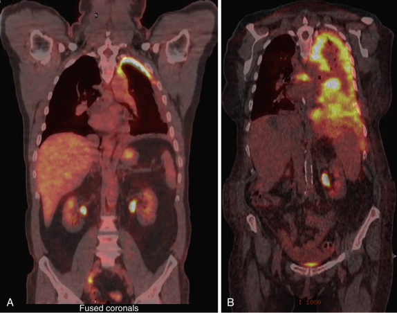 FIG 39-6, A, Coronal fused FDG PET-CT image with localized tumor within the left hemithorax. B, Tumor extending into the abdomen and mediastinal node involvement.