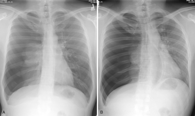 FIG 39-7, Inspiration ( A ) and expiration ( B ) chest radiographs showing a right tension pneumothorax. Note shift of mediastinum to the left with a large right pneumothorax and complete atelectasis of the right lung.