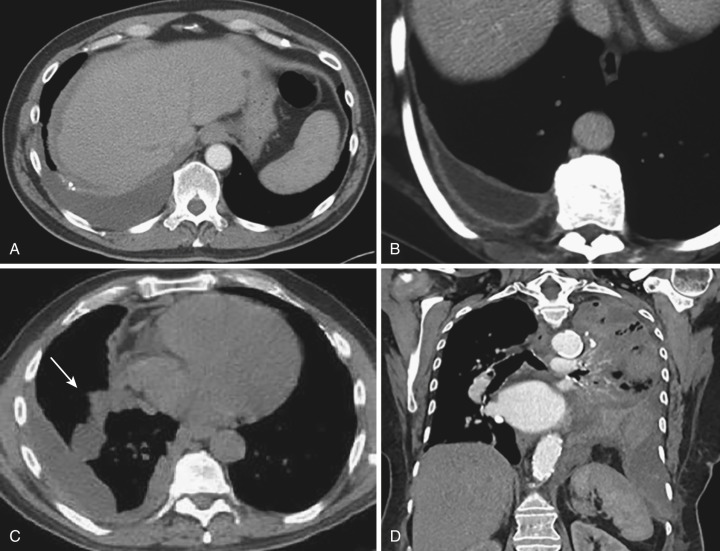 FIG 39-8, A, Axial CT image showing a right-sided transudative effusion in a patient with chronic renal failure. B, Loculated small right pleural effusion with the “split pleura sign” in a patient with empyema. C, Fissural pleural thickening in a patient with right pleural mesothelioma. D, Large left hemothorax after resection of a left-sided bronchogenic cyst.