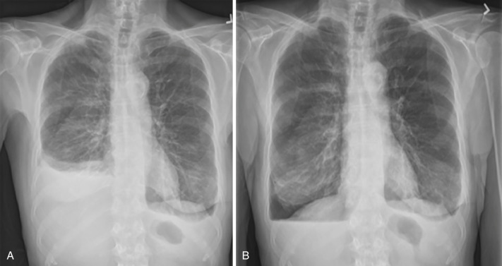 FIG 39-9, Chest PA views before ( A ) and after ( B ) right-sided thoracentesis, showing lucency in the right lower hemithorax (pneumothorax ex vacuo, or “trapped lung”).