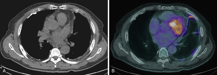 FIG 39-10, A, Axial CT image in a patient with left-sided talc pleurodesis shows subtle high density within the left-sided pleural thickening. B, Axial fused PET-CT image showing diffuse increased FDG uptake, which is more likely to be related to post-pleurodesis inflammation than tumor. It is important to note that radiotracer uptake due to inflammation cannot be definitively differentiated from uptake by tumor.