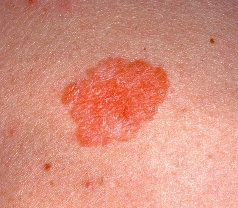 FIG. 3.54, Bowen’s disease, or in situ squamous cell carcinoma, often appears as a scaly, eczematous plaque on the extremities.