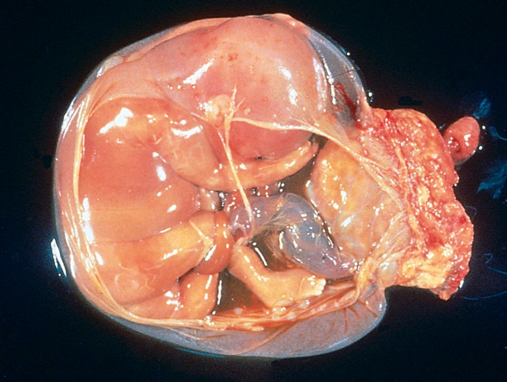 Figure 10.2, Disruption of morphogenesis by an amniotic band. Note the placenta at the right of the diagram and the band of amnion extending from the top portion of the amniotic sac to encircle the leg of the fetus.