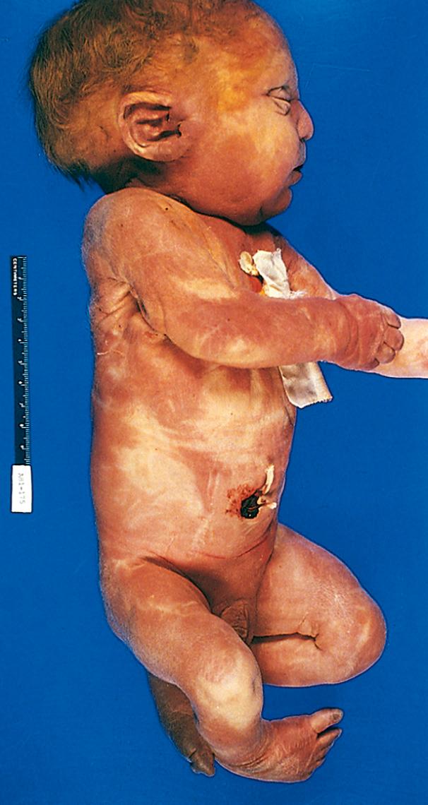 Figure 10.4, Infant with oligohydramnios sequence. Note the flattened facial features and deformed right foot (talipes equinovarus).