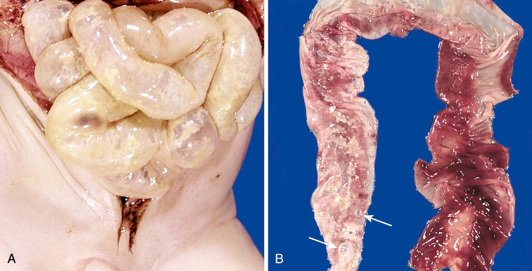 Figure 10.8, Necrotizing enterocolitis (NEC). (A) Postmortem examination in a severe case of NEC shows the entire small bowel is markedly distended with a perilously thin wall (usually this implies impending perforation). (B) The congested portion of the ileum corresponds to areas of hemorrhagic infarction and transmural necrosis microscopically. Submucosal gas bubbles (pneumatosis intestinalis) can be seen in several areas (arrows).