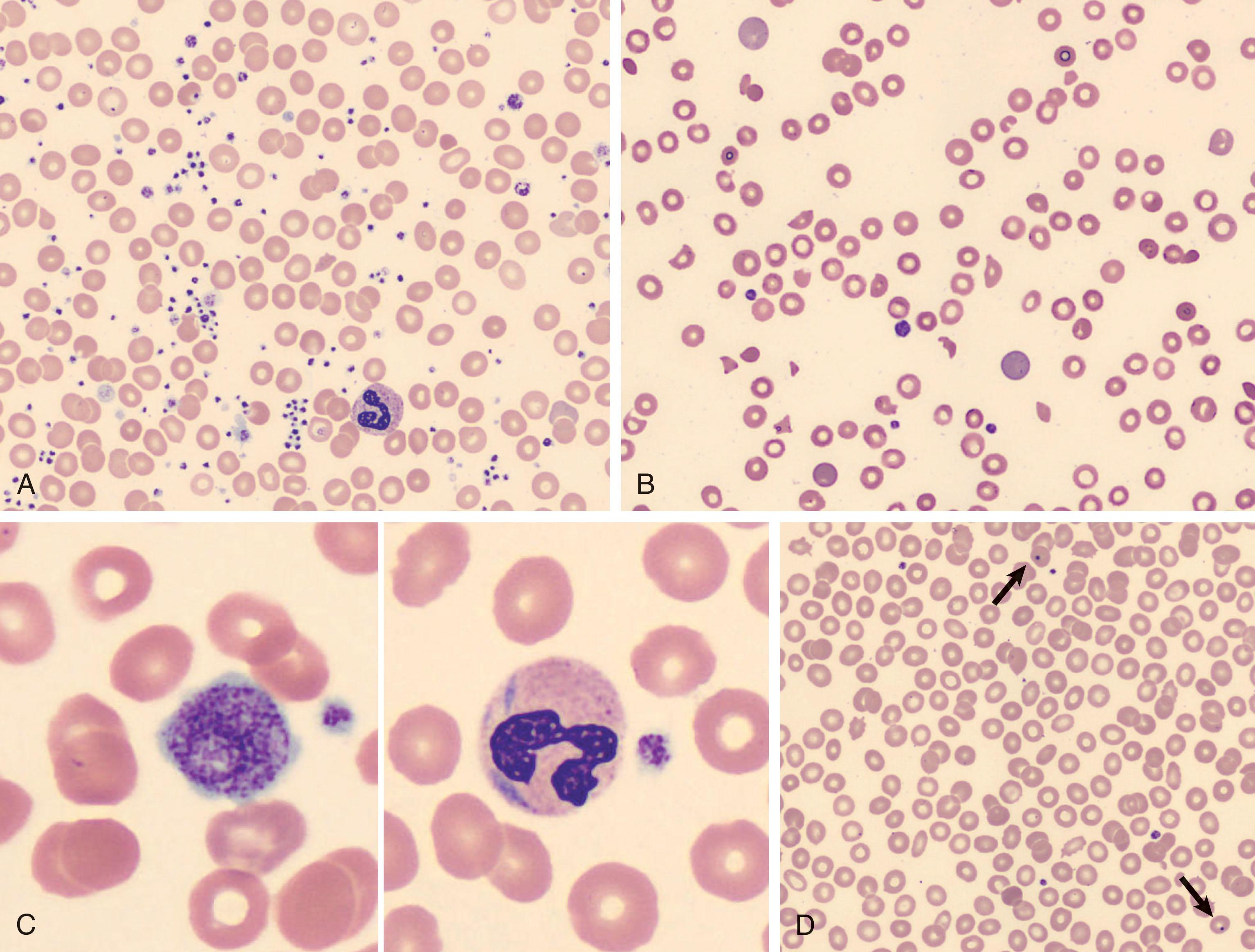 Figure 129.1, BLOOD FILM EXAMINATIONS FROM PATIENTS WITH THROMBOCYTOPENIA.