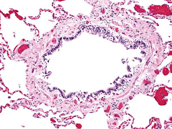 FIG. 21.1, Normal membranous (terminal) bronchiole with ciliated columnar epithelium. The basement membrane is thin, and there is a circumferential layer of smooth muscle that can be distinguished from the connective tissue that surrounds the airway and is contiguous with the alveolar septa. The focal detachment of the epithelium is artifactual.