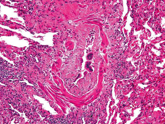 FIG. 21.5, Constrictive bronchiolitis. There is circumferential collagen deposition, causing thickening of the bronchiolar wall and narrowing of the lumen.