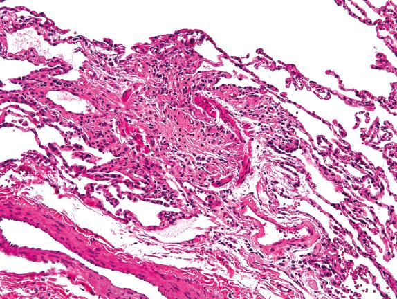 FIG. 21.6, Constrictive bronchiolitis. The lumen of this bronchiole is completely filled by mature collagen.