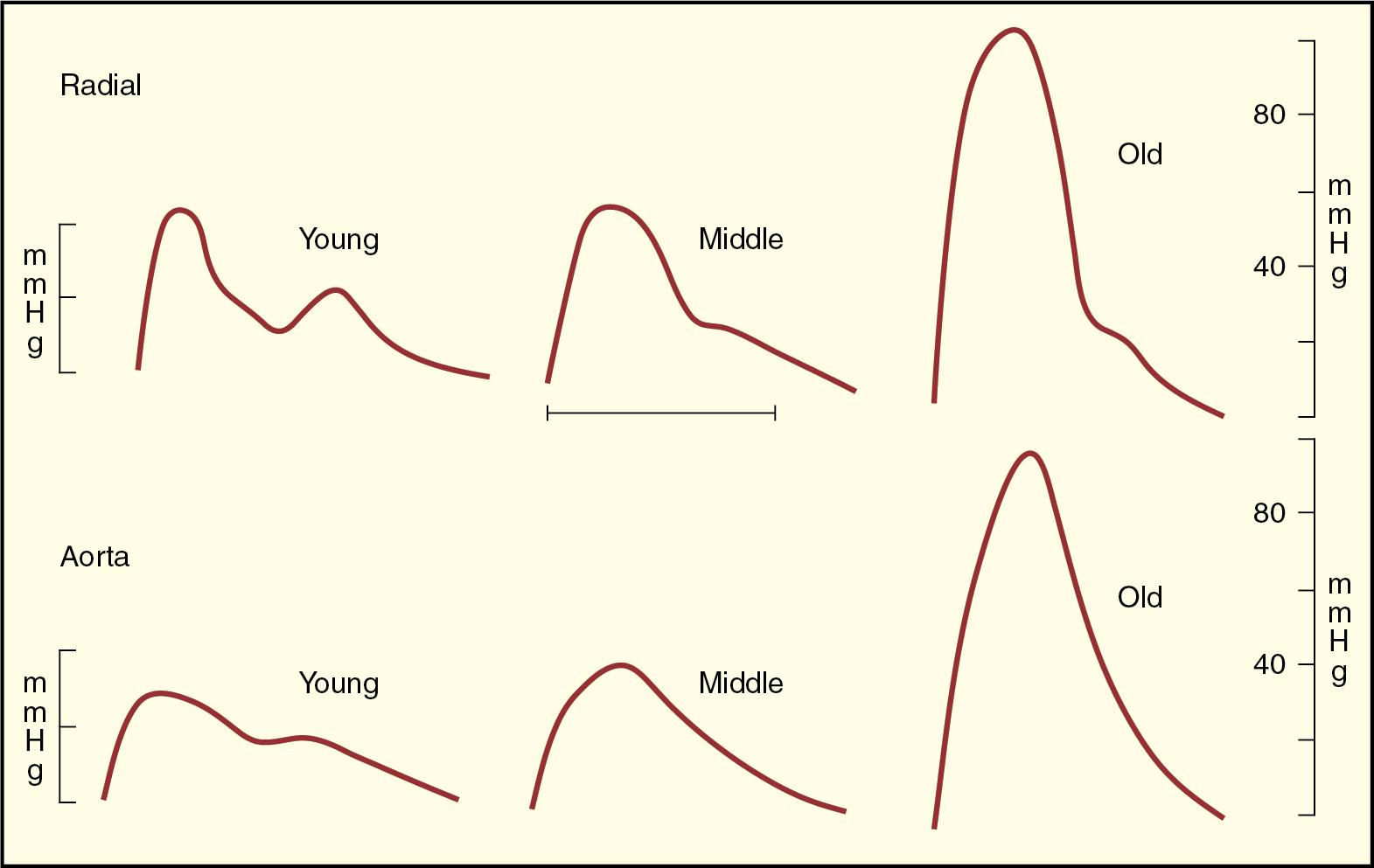 Fig. 30.3, Impact of vascular changes with aging on pulse waveforms of the ascending aorta and radial artery. Pulse pressure is increased almost fourfold in the ascending aorta and twofold in the upper limb.