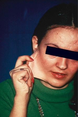 Fig. 21.1, Ehlers-Danlos syndrome: this female shows hyperelastic skin, hypertelorism, and a widened nasal bridge.