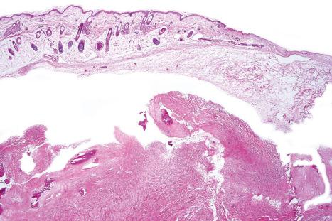 Fig. 21.12, Aplasia cutis: note the loss of appendages on the right side of the field.