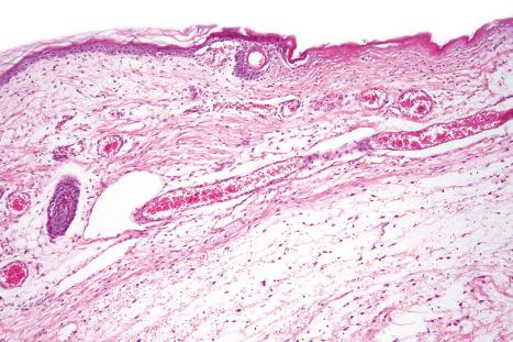 Fig. 21.13, Aplasia cutis: there is ulceration.