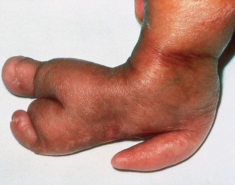 Fig. 21.16, Focal dermal hypoplasia: skeletal manifestations are an important feature.