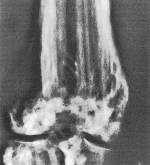 Fig. 21.17, Focal dermal hypoplasia: radiograph showing characteristic axially oriented dense striations of osteopathia striata of the lower femur of a 35-year-old man.