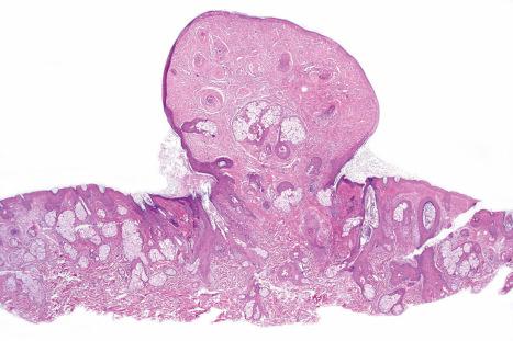 Fig. 21.21, Tuberous sclerosis: scanning view of a small polypoid lesion showing diminution of appendage structures and marked fibrosis.