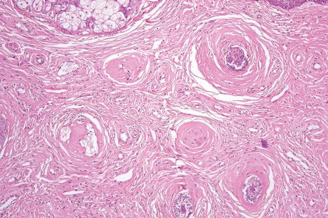 Fig. 21.23, Tuberous sclerosis: this view highlights the concentric perifollicular fibrosis.