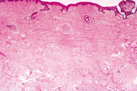 Fig. 21.24, Tuberous sclerosis: shagreen patch. The dermis is replaced by dense, relatively acellular collagen which extends down to the subcutaneous fat.