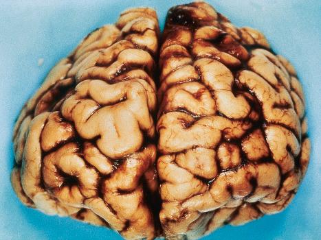 Fig. 21.26, Tuberous sclerosis: the brain is reduced in size and the gyri are markedly broadened.