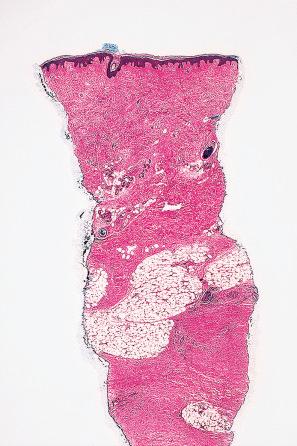 Fig. 21.33, Nephrogenic fibrosing dermopathy: there is diffuse fibrosis involving the full thickness of the dermis and extending into the septa of the subcutaneous fat.