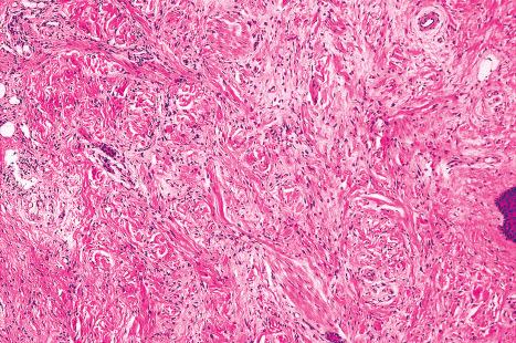 Fig. 21.34, Nephrogenic fibrosing dermopathy: there is a conspicuous spindle cell population.