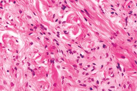 Fig. 21.35, Nephrogenic fibrosing dermopathy: high-power view.