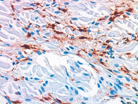 Fig. 21.38, Nephrogenic fibrosing dermopathy: factor XIIIa-positive cells are conspicuous.