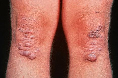 Fig. 21.7, Ehlers-Danlos syndrome: trauma to the subcutaneous tissues around the knees has resulted in these ‘pseudotumors’.