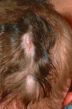 Fig. 21.8, Aplasia cutis: characteristic scarring with alopecia on the back of the head.