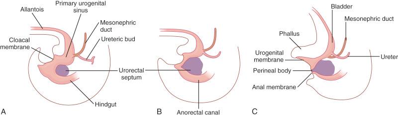 Fig. 10.1, Embryology of anorectal development. A, The urorectal septum begins as a horizontal shelf of mesenchyme at week 5. B, Progressing toward the cloacal membrane by week 7. C, Completing the separation of the urogenital sinus and rectum by week 8.