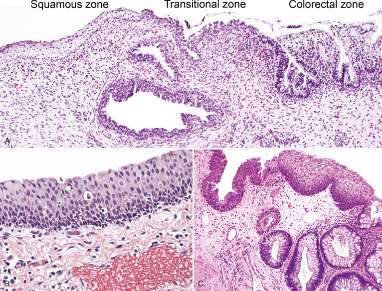 Fig. 10.4, Histologic zones of the anal canal. A, Fetal anal canal, demonstrating squamous, transitional, and colorectal zones. Note the anal ducts present in the stroma below the anal transition zone (ATZ), with identical ATZ-type epithelial lining. B, ATZ mucosa composed of basal cells and overlying columnar to cuboidal cells. C, ATZ mucosa may demonstrate histologic heterogeneity, including islands of squamous and colorectal epithelium.