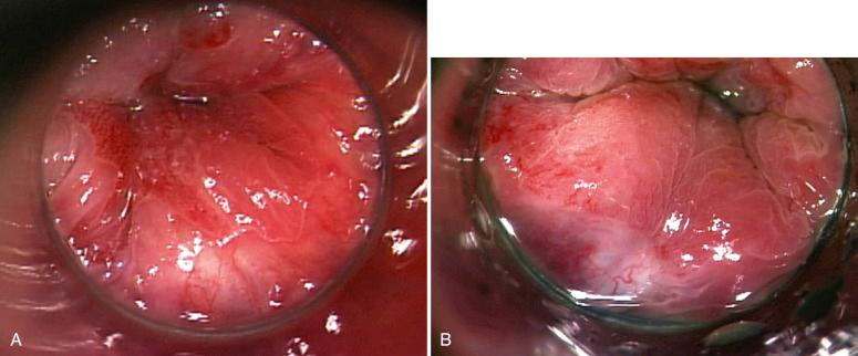 Fig. 10.5, A, Anal squamocolumnar junction. B, Anal squamocolumnar junction—closer view showing pinker squamous epithelium and darker columnar epithelium. The thin white line at the right side between the two represents the transition zone.