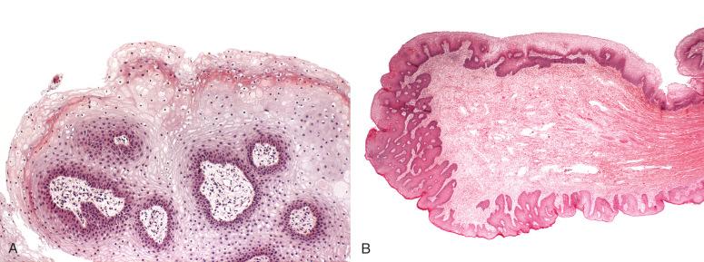 Fig. 10.7, Fibroepithelial stromal lesions. A, Acrochordon. B, Fibroepithelial stromal polyp.