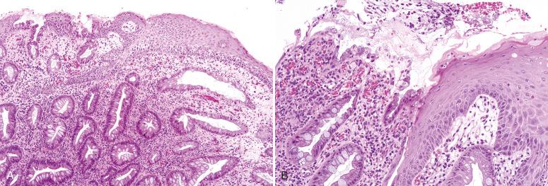 Fig. 10.8, Inflammatory cloacogenic polyp. A, Low-power image. B, Higher power image illustrating a mixture of intestinal and squamous epithelium.