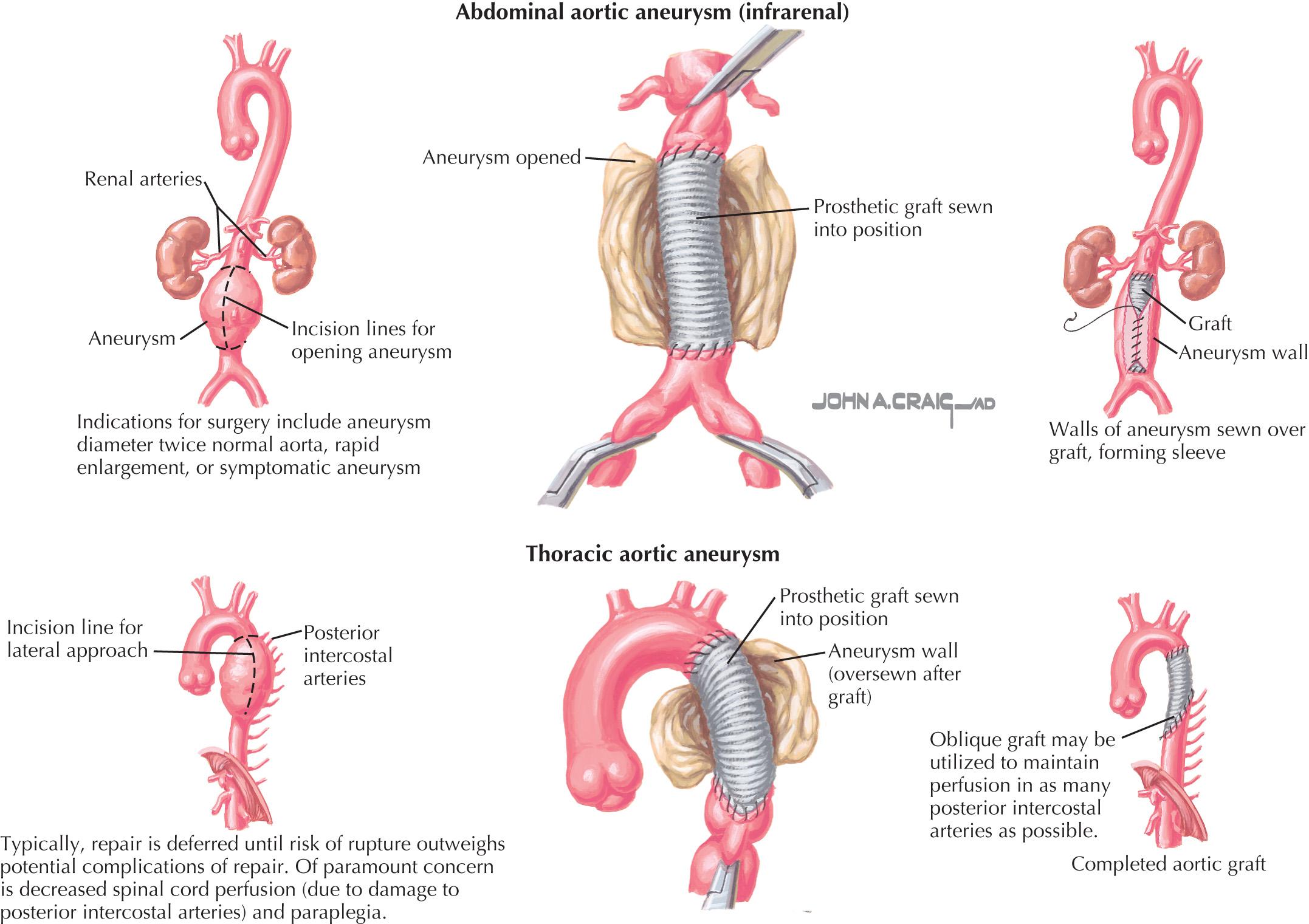 FIG 62.1, Surgical Management of Aortic Aneurysms.