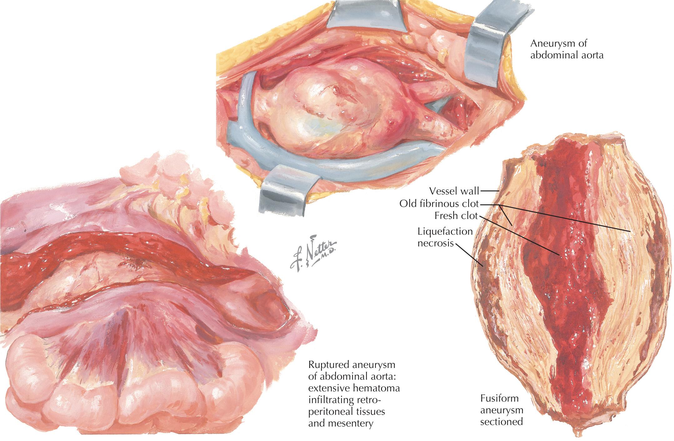 FIG 62.2, Surgical View of Aortic Aneurysms.