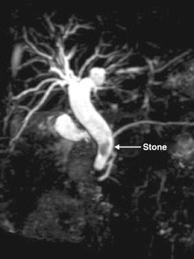 Fig. 35.1, Magnetic resonance cholangiographic image showing a large stone ( arrow ) in the distal bile duct.