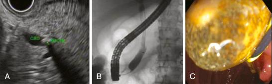 Fig. 35.2, Endoscopic ultrasonographic (EUS) image of a bile duct (CBD) stone (A), which is not noted on a subsequent cholangiogram (B), and finally extracted after a formal sweep of the bile duct is performed (C), thereby demonstrating the sensitivity of EUS for BD stones.